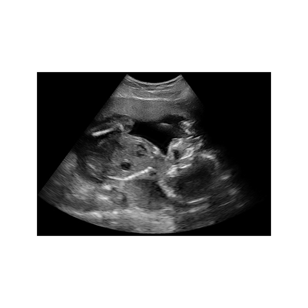 Untersuchung des Fötus Clarius HD3 Ultraschallsystem Anwendung