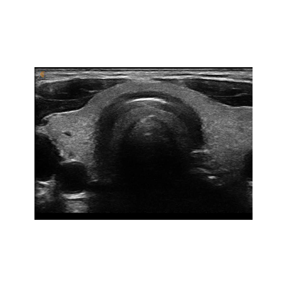 Sonografie der Schilddrüse Clarius HD3 Ultraschallsystem Schilddrüse