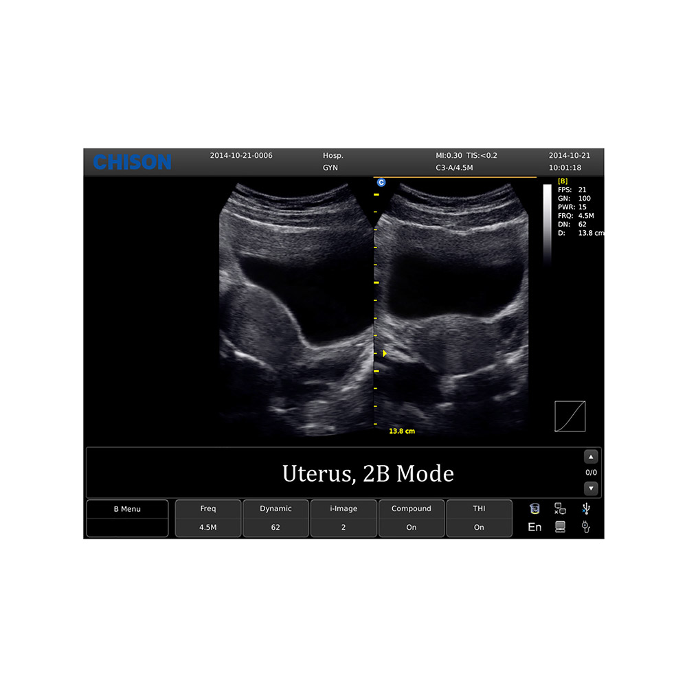 Anwendungsbild: Untersuchung des Uterus (im 2B-Modus) Chison ECO 1 Ultraschallgerät