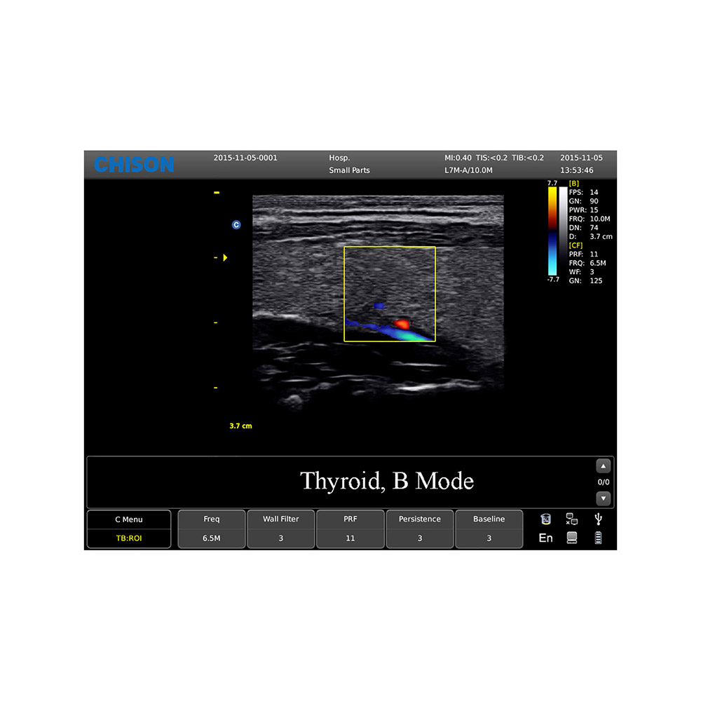 Anwendungsbild Thyroid CHISON ECO5 Ultraschallgerät mit Farbdoppler