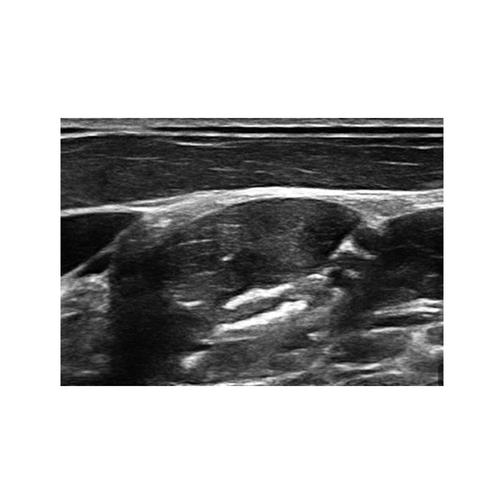 Sonografie eines interskalenären Nervs Clarius HD3 Ultraschallsystem Nerven-Sono