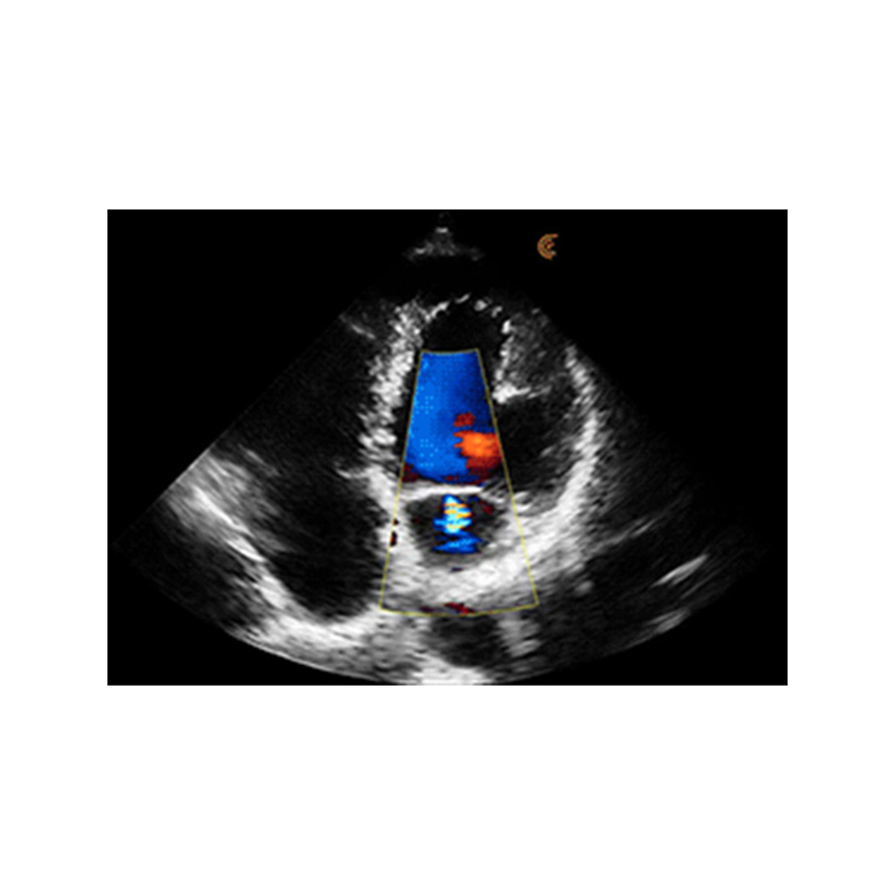 Untersuchung des Herzens mit Farbdoppler Clarius HD3 Ultraschallsystem Untersuchung
