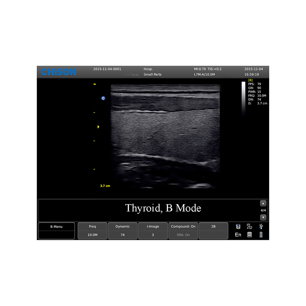 Anwendungsbild Thyroid CHISON ECO3 Expert Ultraschallgerät