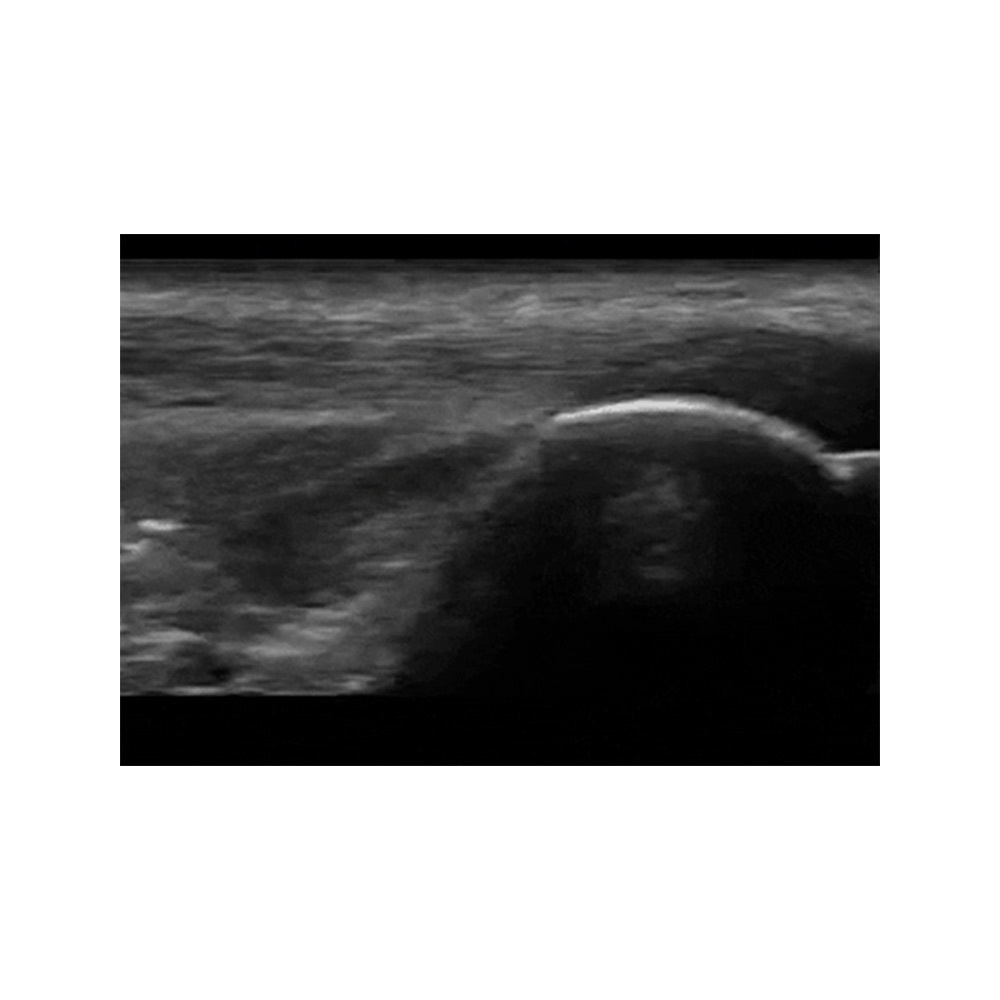 Sonografie der Partella Clarius HD3 Ultraschallsystem Kniescheibe